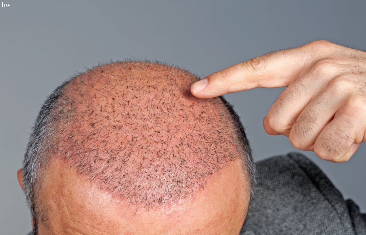 8 советов восстановления после пересадки волос - рис